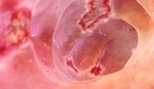 Pathophysiology of Crohn’s disease