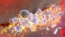Thrombosis and Inflammation