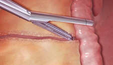 Virtual laparoscopic surgery