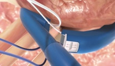 Cardiac ablation system