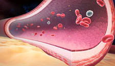 Hypertension DVD