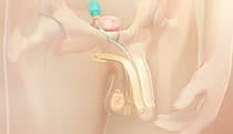 Inflatable penile prosthesis
