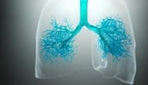 Progression of COPD